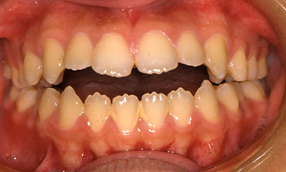 前歯が噛み合っていない(開咬) 治療前01