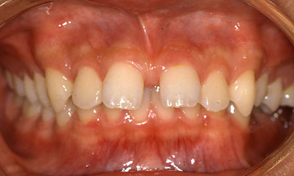上の歯の内側に下の歯が軽く接触し、鋏（ハサミ）のようになっている（鋏状咬合） 治療前01