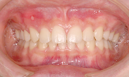 上の歯の内側に下の歯が軽く接触し、鋏（ハサミ）のようになっている（鋏状咬合） 治療後01