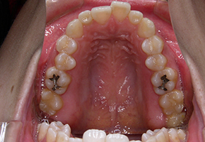 歯の舌側からの見えない矯正治療 治療前