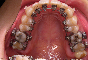 歯の舌側からの見えない矯正治療 治療中