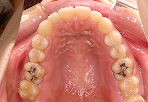 歯の舌側からの見えない矯正治療 治療後