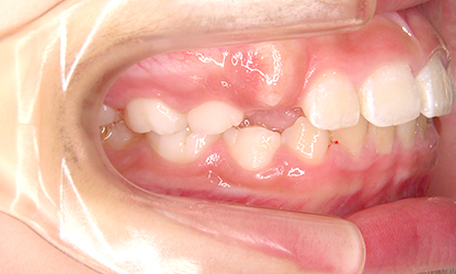 出っ歯（上顎前突） 治療後01
