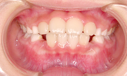 前歯が噛み合っていない（開咬）-CASE1 治療後01