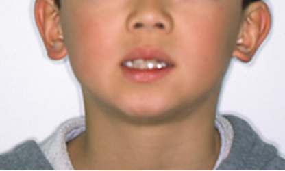 歯の前後関係が逆転している（逆被蓋） 治療前02