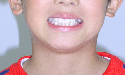 歯の前後関係が逆転している（逆被蓋） 治療後02