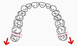 01.奥歯を後方に移動させる方法