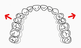 02.歯並びのアーチを広げる方法